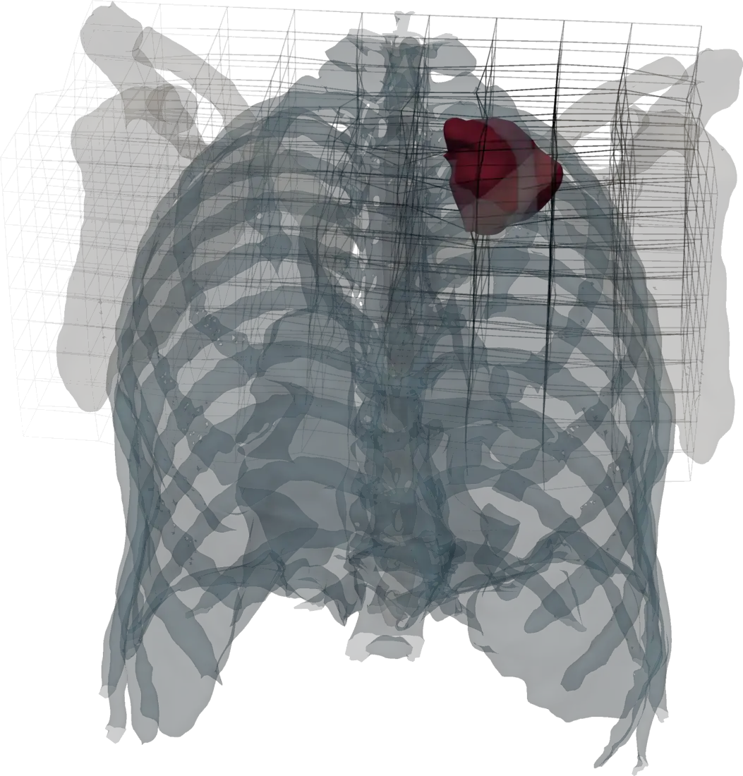 3D rendering of a thorax with a highlighted lesion inside a deformed registration grid
